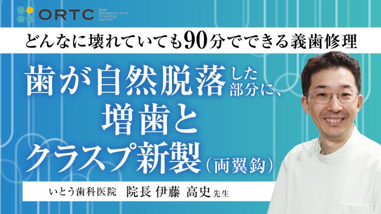歯が自然脱落した部分に、増歯とクラスプ新製（両翼鈎） 伊藤高史