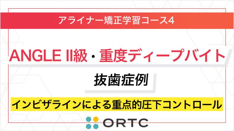 ANGLE II級・重度ディープバイト抜歯症例：インビザラインによる重点的圧下コントロール ORTC