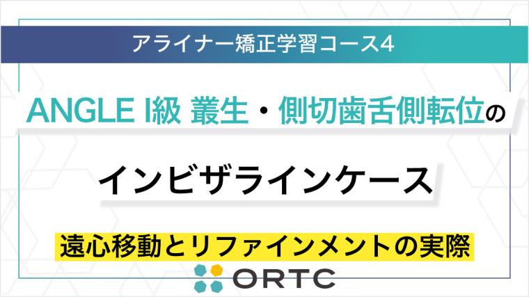 ANGLE I級 叢生・側切歯舌側転位のインビザラインケース：遠心移動とリファインメントの実際 ORTC