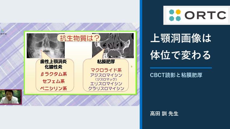 歯科用CBCTで上顎洞をどう読む？体位差とマクロライド療法 高田訓