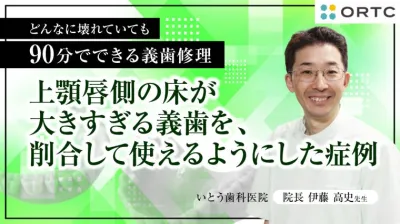 上顎唇側の床が大きすぎる義歯を、削合して使えるようにした症例