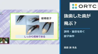 抜歯した歯が飛ぶ？誤嚥・窒息を防ぐ鉗子操作