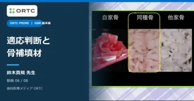 GBRの可能性と必要性 基本編｜適応判断と骨補填材