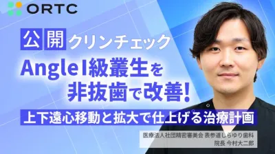 公開クリンチェック Angle1級叢生を非抜歯で改善！上下遠心移動と拡大で仕上げる治療計画	