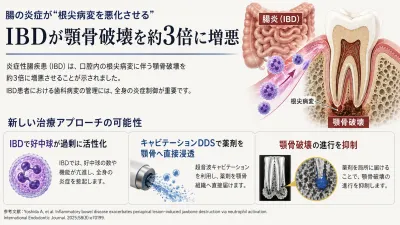 腸の炎症が“根尖病変を悪化させる”ことが判明