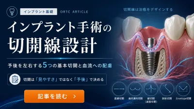 インプラント手術の切開線設計｜予後を見据えた5つ…