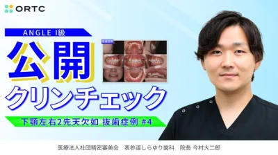 ANGLEI 級 下顎左右2先天欠如（抜歯症例）