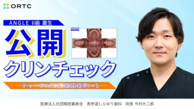 ANGLE II級叢生ディープバイト（抜歯症例）
