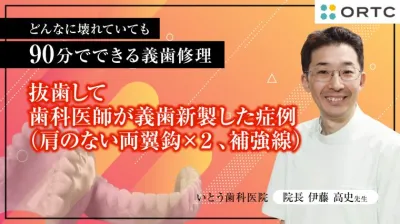 抜歯して歯科医師が義歯新製した症例（肩のない両翼鈎×２、補強線）