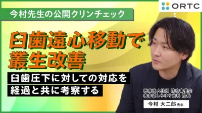 臼歯遠心移動で叢生改善:臼歯圧下に対しての対応を経過と共に考察する