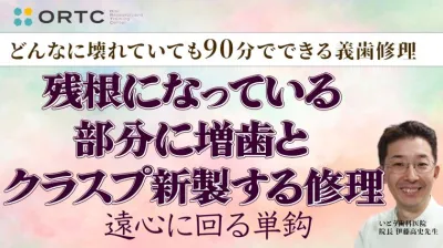 残根になっている部分に増歯とクラスプ新製する修理（遠心に回る単鈎）