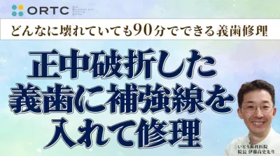 正中破折した義歯に補強線を入れて修理