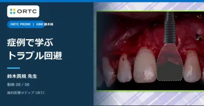GBRの可能性と必要性 基本編｜症例とトラブル回避